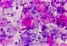 Decoding the Complex Link Between HPV Infections and Cervical Cancer: A Breakthrough Study