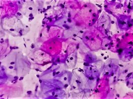 Decoding the Complex Link Between HPV Infections and Cervical Cancer: A Breakthrough Study