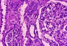 Discovery of Mutational Signature for Kidney Cancer Recurrence Prediction